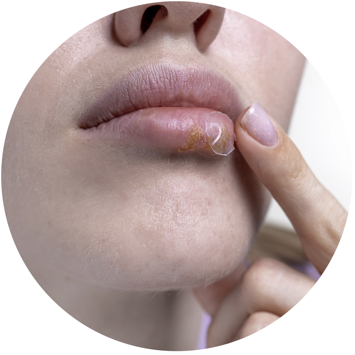 hpv lip