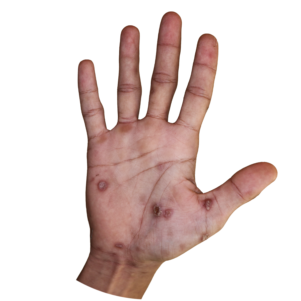 syphillis hand